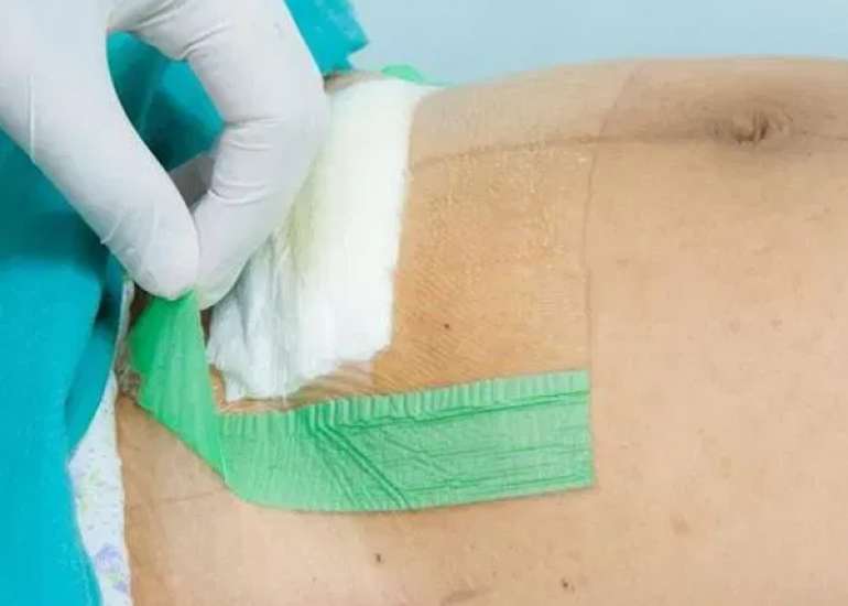 Surgical Approach to Mitigate Risks and Improve Outcomes in Cesarean Section