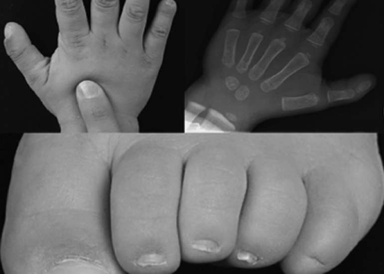 Diagnosis and Management of HPMRS3 in a 2-Year-Old Boy with Developmental Delay and Elevated Alkaline Phosphatase