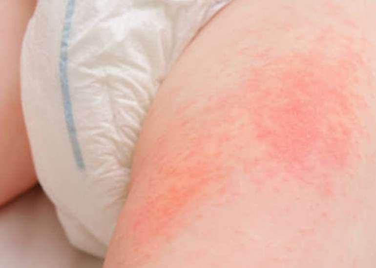 Traditional and Modern Practices in Managing Diaper Dermatitis in Young Children