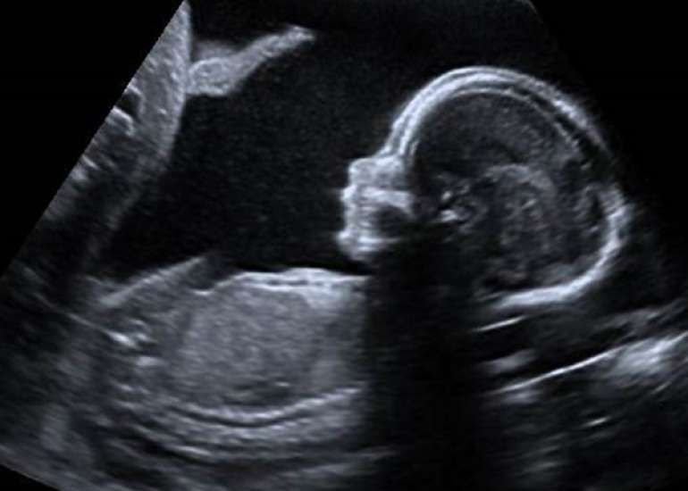 Nuchal Translucency as a Predictor of Congenital Heart Defects in Early Pregnancy