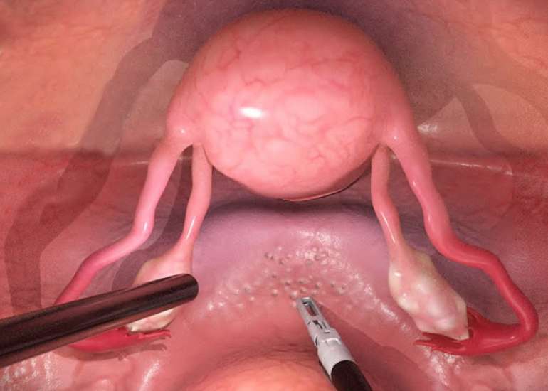 Association Between Previous Surgical Treatment and Outcomes of Repeat Endometriosis Surgery