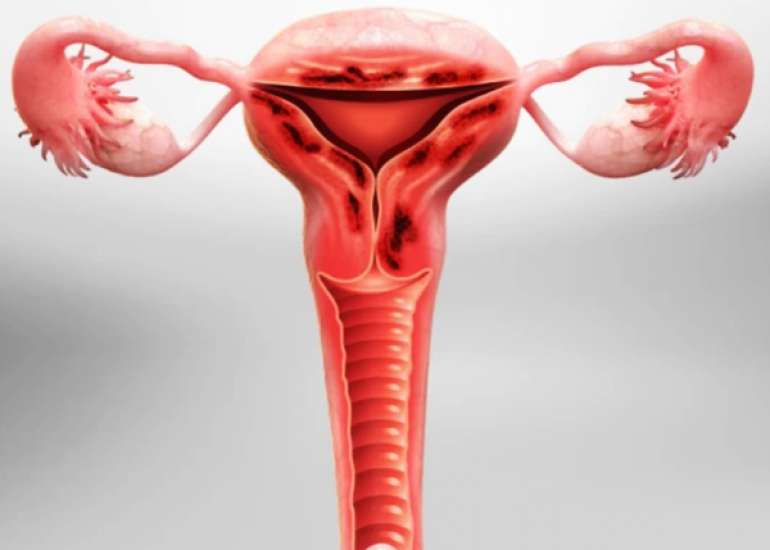 Fertility Prognosis in Adenomyosis: The Role of Pelvic Adhesions Post-HIFU