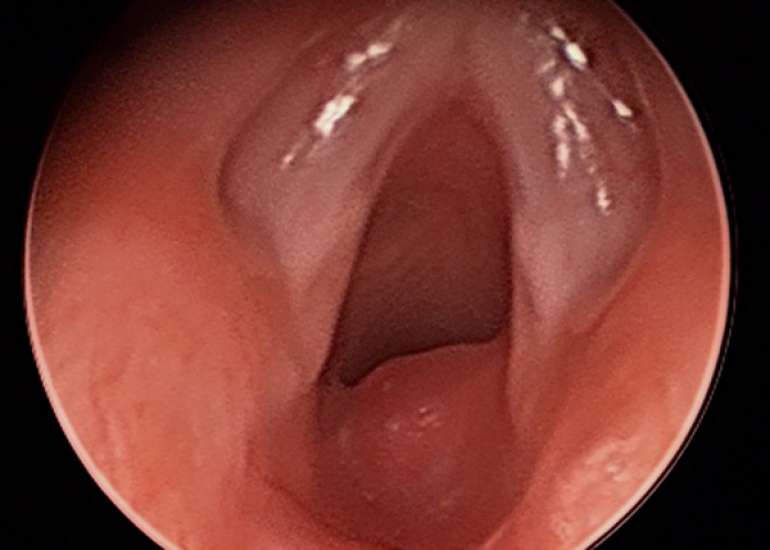 Pediatric Supraglottic Hemangioma Causing Airway Obstruction: A Case Report