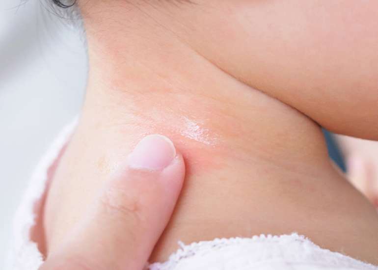 Determinants of the Atopic March in Children with Early-Onset Atopic Dermatitis