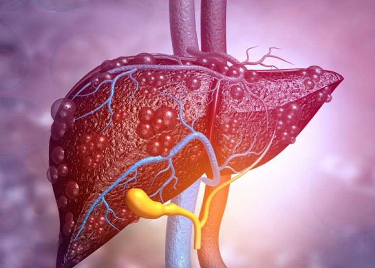 Metabolic Steatotic Liver Disease in Adults: A Comprehensive Review