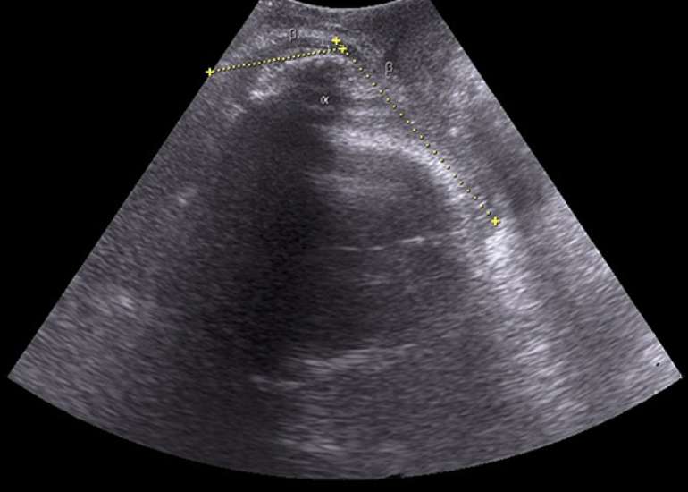 Intrapartum Sonography: Redefining Evaluation of Fetal Head Position