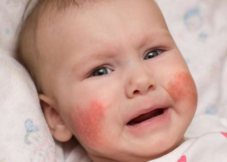 Managing Childhood and Adolescent Atopic Dermatitis in Primary Care