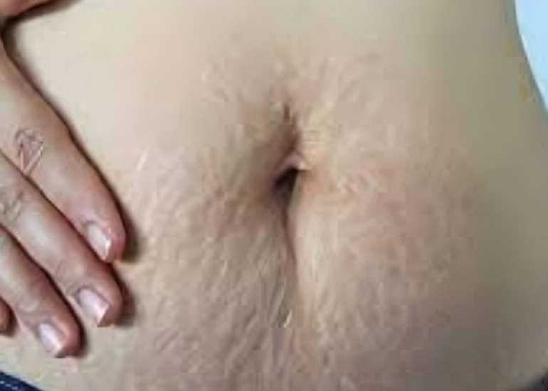 Pelvic Floor Dysfunction Two Decades After Childbirth: Urinary, Fecal Incontinence, and Prolapse