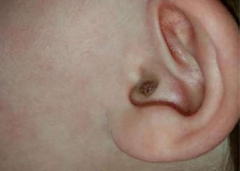 Atypical Right Atrial Mass in a Neonate: Myxoid Spindle Cell Tumor Case Report