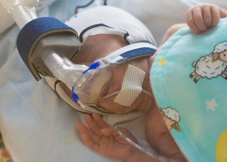 Study Finds Comparable Outcomes for Acetaminophen and COX Inhibitors in PDA Treatment