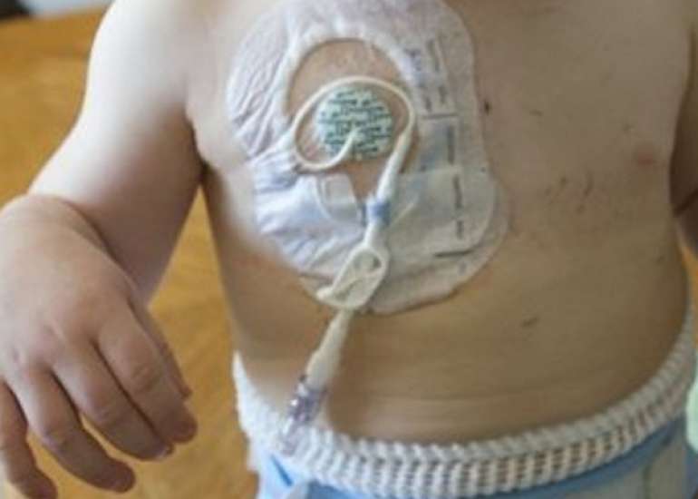 Mastering Ultrasound-Guided Percutaneous Central Venous Port Placement in Pediatric Surgery: Navigating the Learning Curve