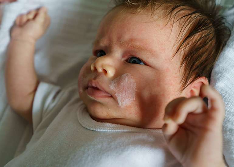 Understanding the Infant Skin Barrier