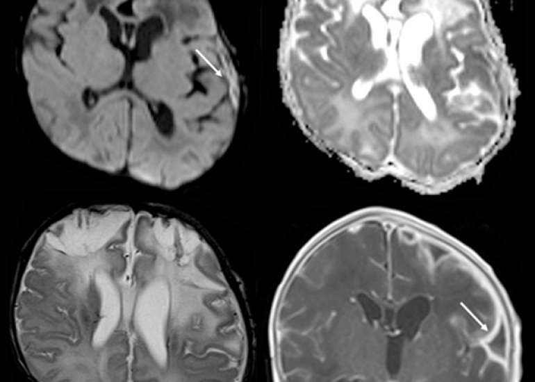Neonatal Paenibacillusthiaminolyticus Infection: A Rare Case of Sepsis and Meningoencephalitis