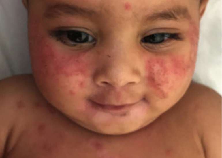 Survey Reveals Key Gaps in Parental Awareness of Atopic Dermatitis in Indian Children