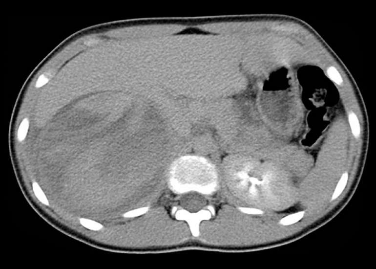 Incidental Findings on Abdominal CT in Pediatric Blunt Trauma: A Prevalence Study