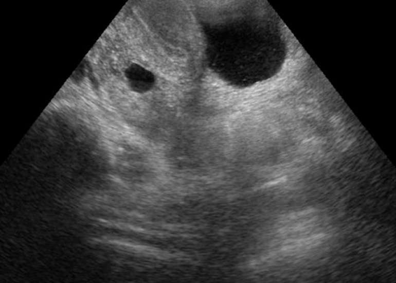 A Rare Case of Second-Trimester Ovarian Pregnancy Rupture With Neurologic Presentation