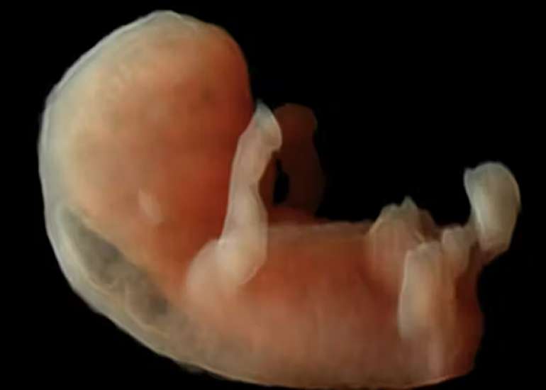 Re-evaluating Nuchal Translucency Cut-offs in First-Trimester Screening