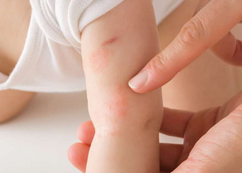Predictors of Atopic March Progression in Children with Early-Onset Atopic Dermatitis