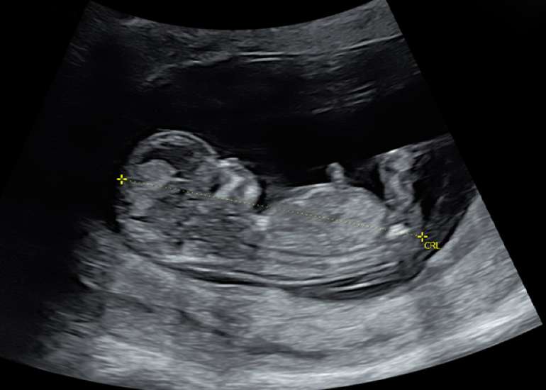 Complex Exomphalos in a Chromosomally Normal Fetus: A Case Report
