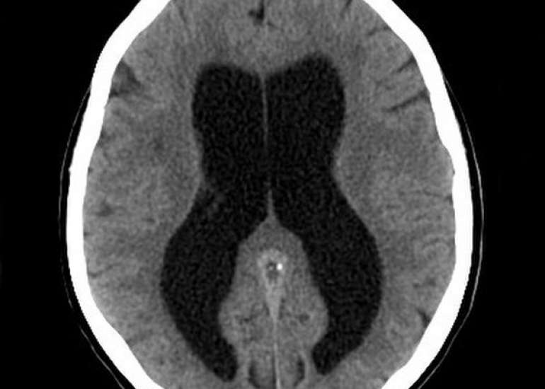  हाइड्रोसिफ़लस कितना गंभीर? लक्षण, कारण और इलाज | Hydrocephalus in Hindi
