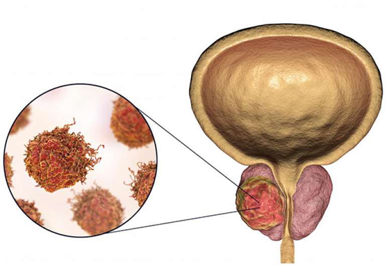 5 year survival rate in prostate cancer