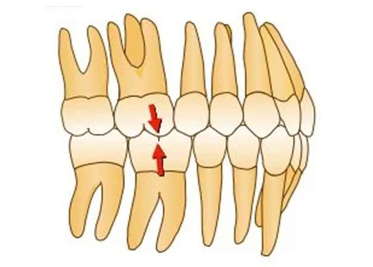 A Comparative Assessment of the Upper Pharyngeal Airway Dimensions among Different Anteroposterior Skeletal Patterns in 7–14-Year-Old Children: A Cephalometric Study