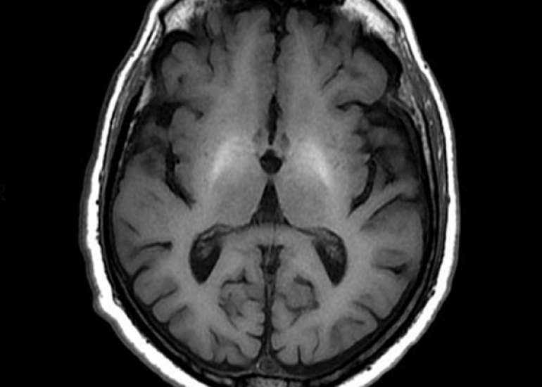 A Genetic Cause of Hyperammonemic Encephalopathy in an Infant