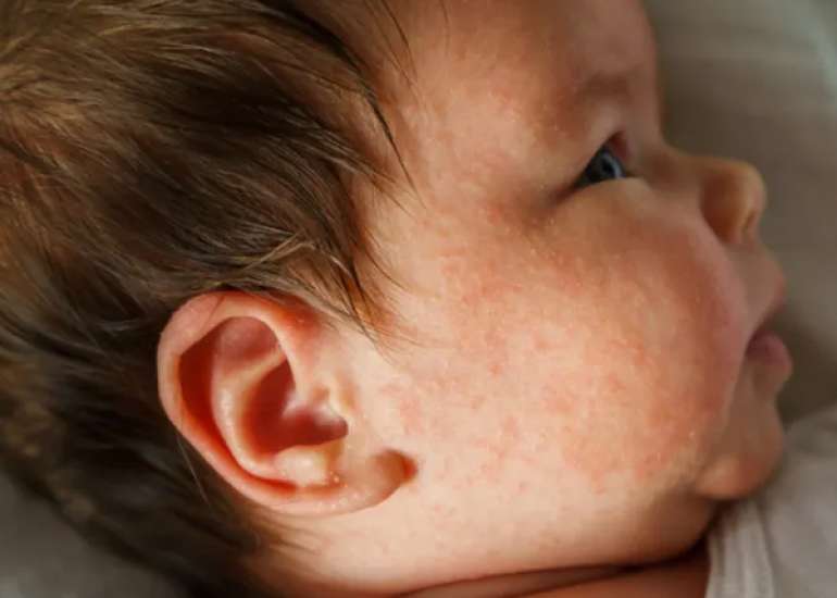 A narrative review on the management of moderate-severe atopic dermatitis in pediatric age of the SIAIP, SIDerP, and SIP