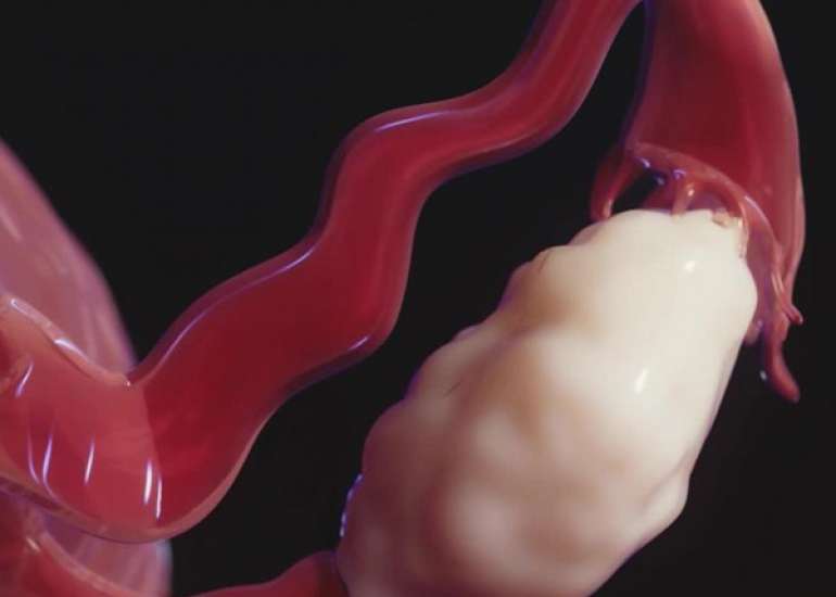 A Nulliparous Intraoperative Case of Adnexal Torsion