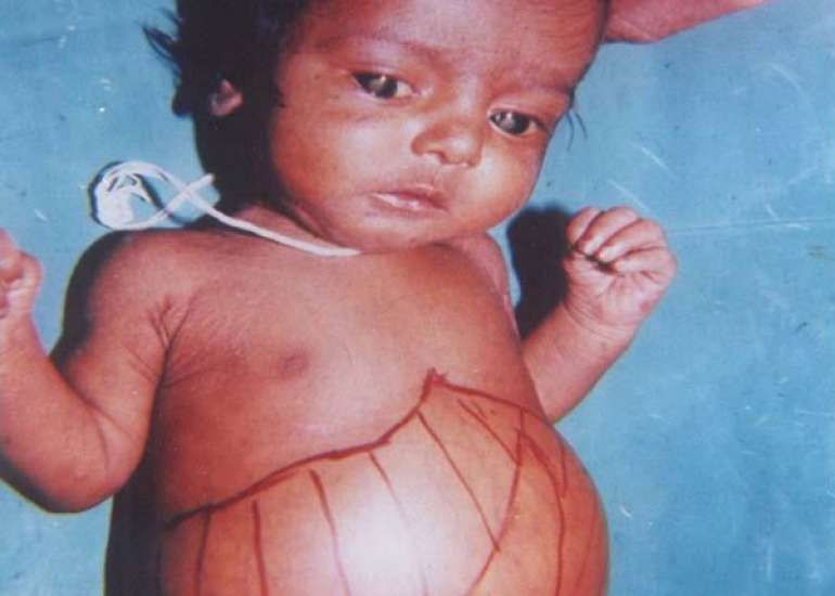 A Rare Case Report of Fatal Fulminant Hepatic Failure in a Child