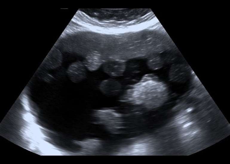 A Rare Presentation of Dual Ovarian Pathologies