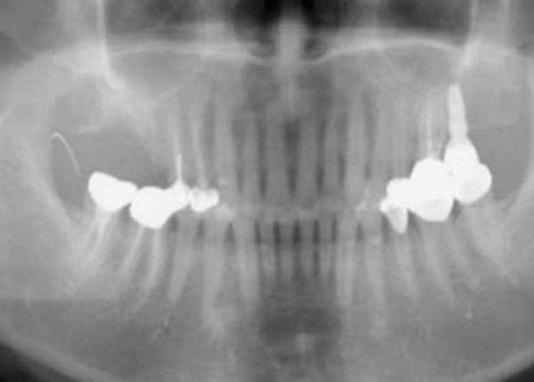 A Retained Broken Suture Needle Retained During Cerclage Placement