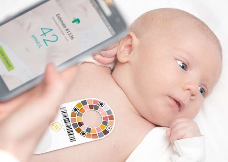 A Smartphone application to quantify jaundice in neonates