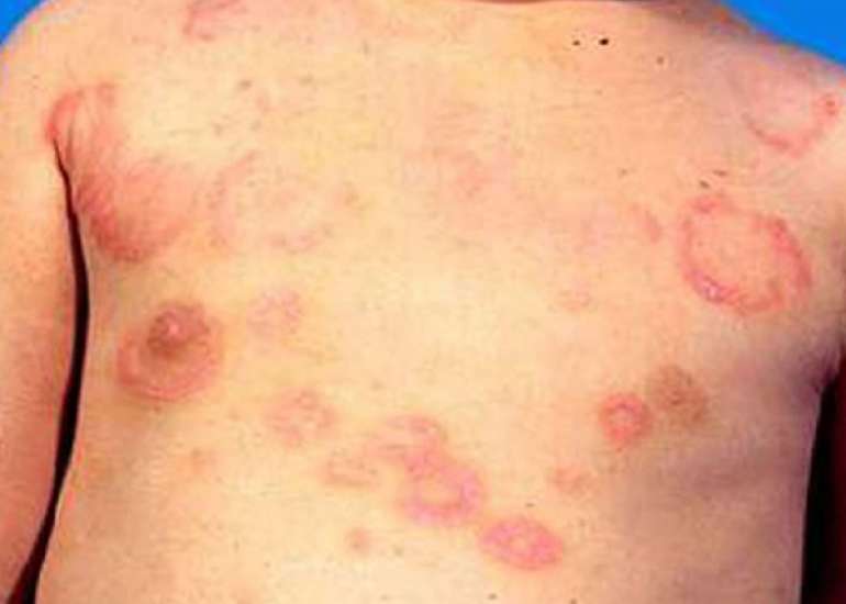 A case of Erythema Marginatum