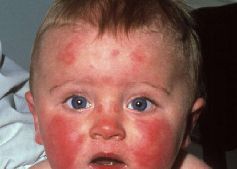 A guide to identifying pediatric patients with multisystem inflammatory syndrome in those presenting to a pediatric emergency department