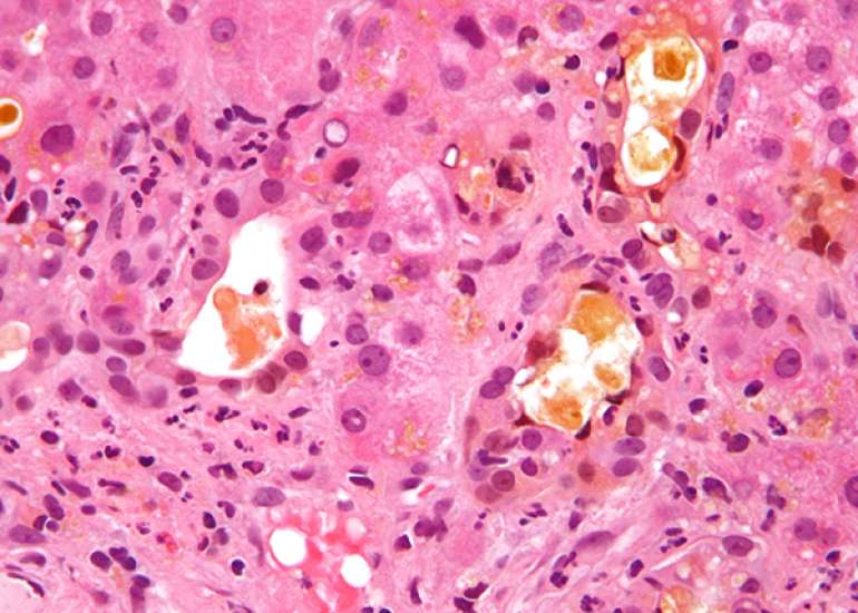 A pregnancy with markedly elevated alkaline phosphatase