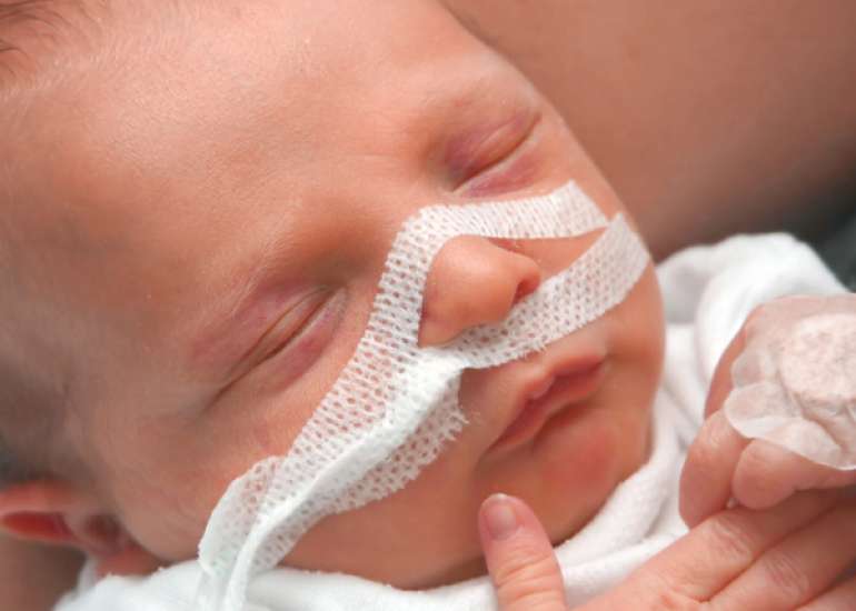 A premature baby with respiratory distress