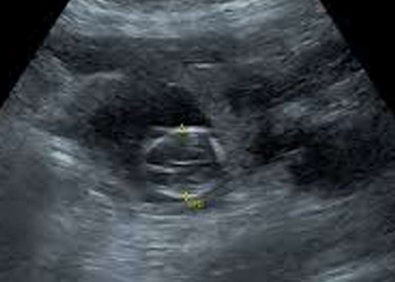 A rare and unusual case of bilateral tubal ectopic pregnancies