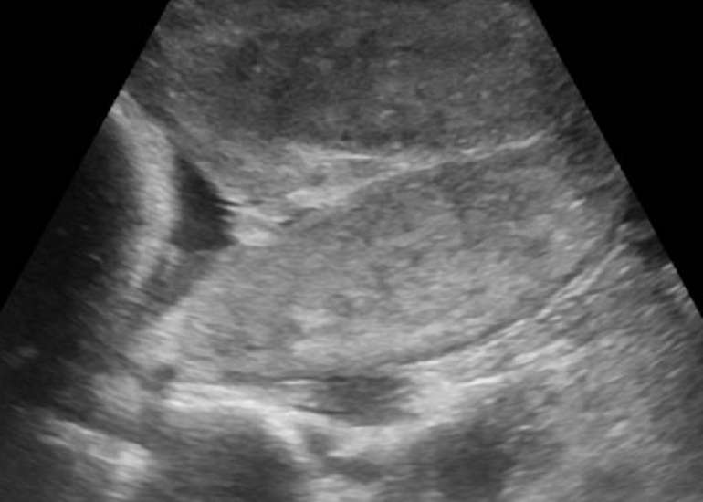 A rare correlation between Spontaneous Uterine Rupture (UR) and Adenomyosis