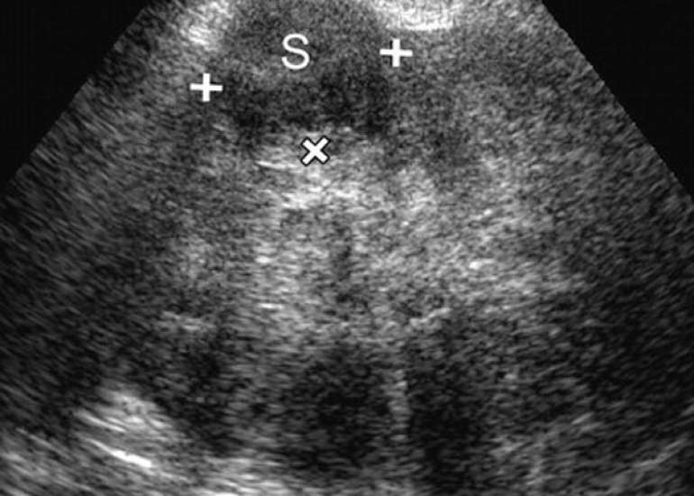 A systematic review and meta-analysis of obstetric and maternal outcomes after prior uterine artery embolization