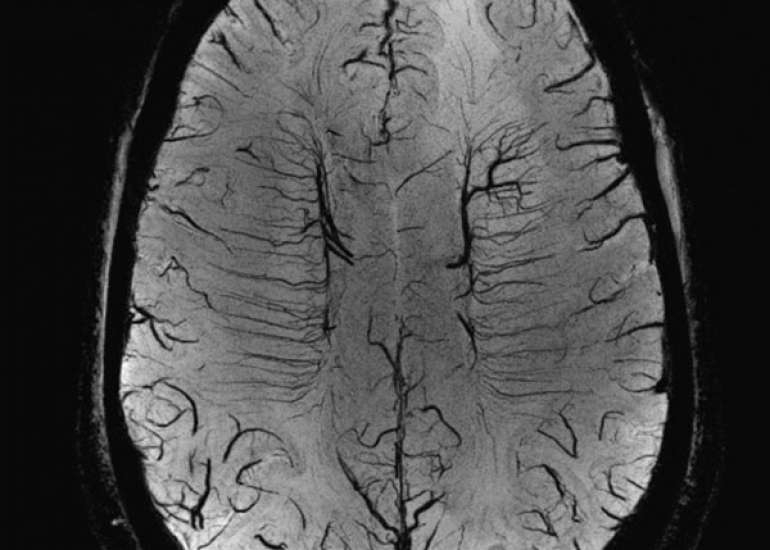 Accessible pediatric neuroimaging using a low field strength MRI scanner