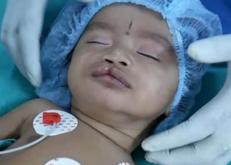 Accuracy of Advanced Pediatric Life Support Intubation Depth Formula in Indian Children 