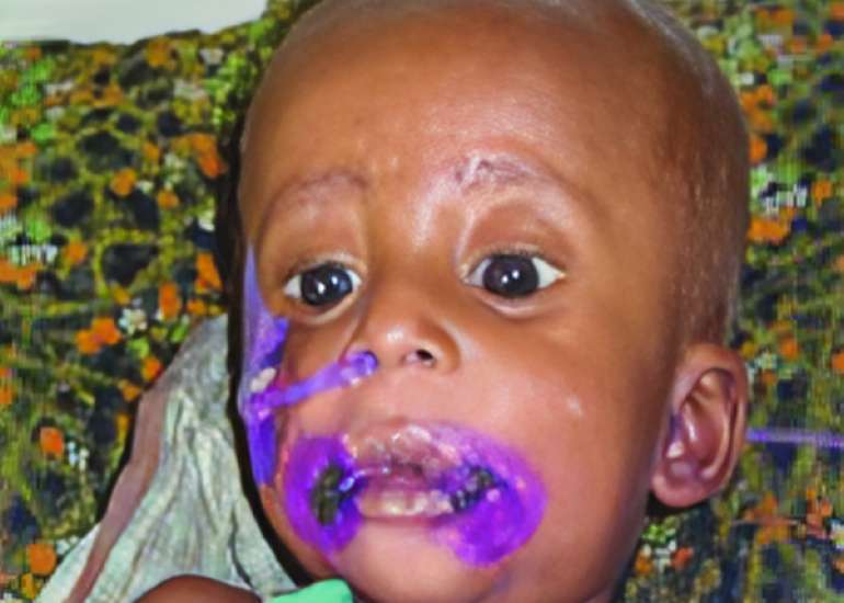 Acute Cheilitis with Oseltamivir 