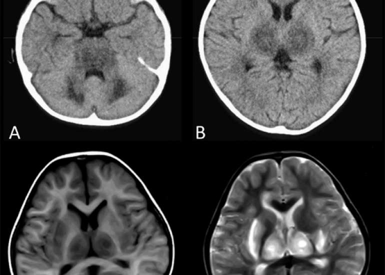 Acute hemorrhagic encephalitis in a pregnant woman
