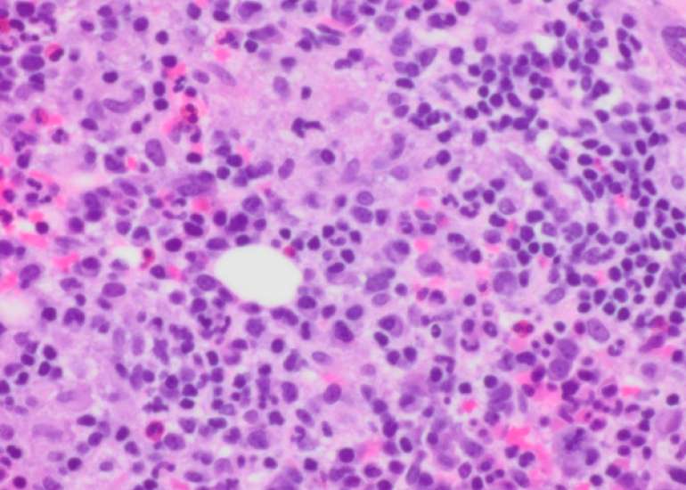 Adenovirus-associated HLH with coronary involvement 