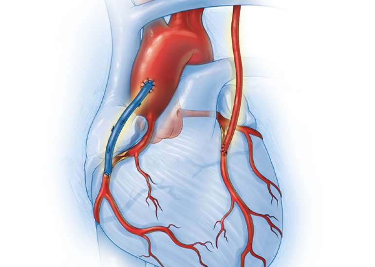 After how much time can a non-cardiac surgery be done after bypass surgery?