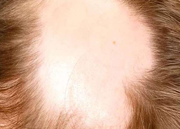 Alopecia Universalis Treatment in a Child with Down Syndrome