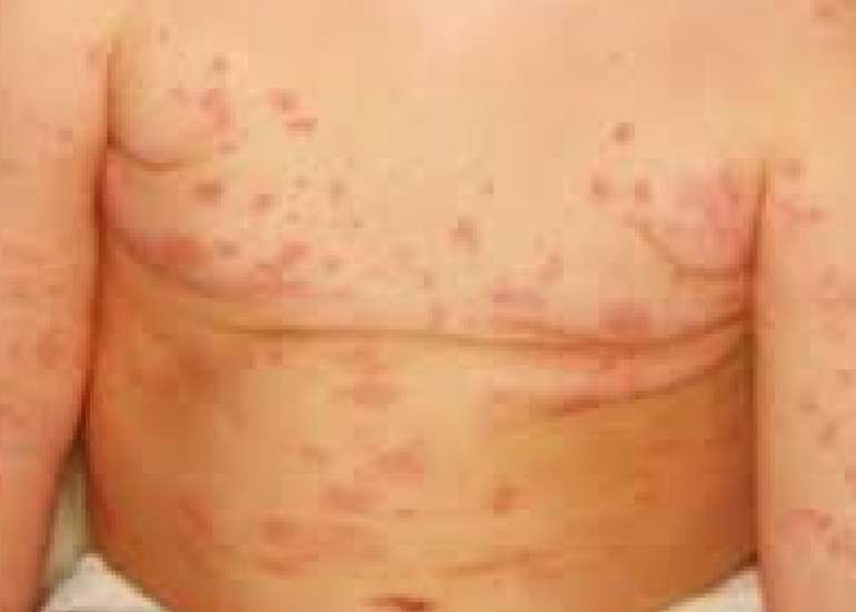 Alpha-gal syndrome misdiagnosed as chronic spontaneous urticaria in a pediatric patient.