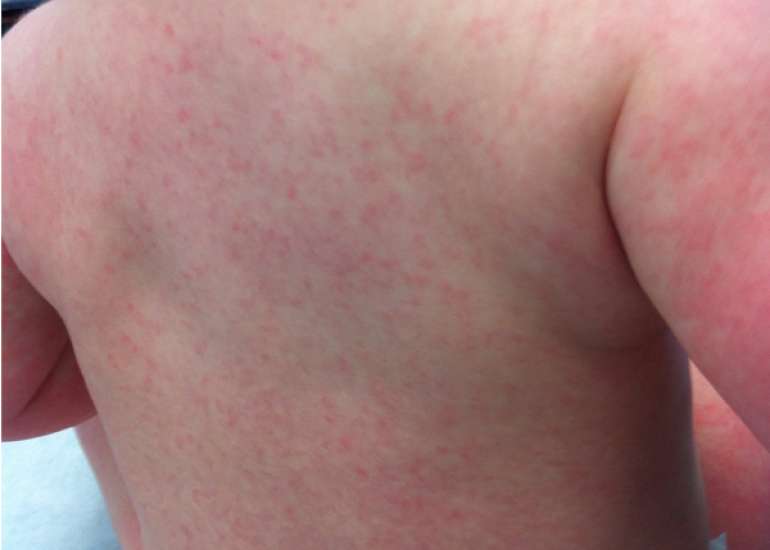 Antibiotic Exposure Increases the Risk of Rash in Children with Infectious Mononucleosis