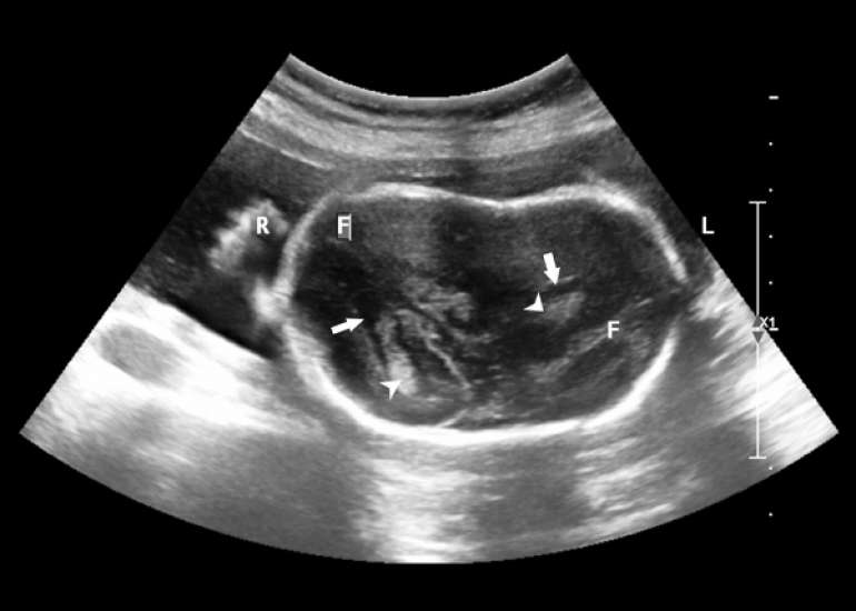 Application of Magnetic Resonance Imaging and Ultrasound Fusion Technology in Gynecology